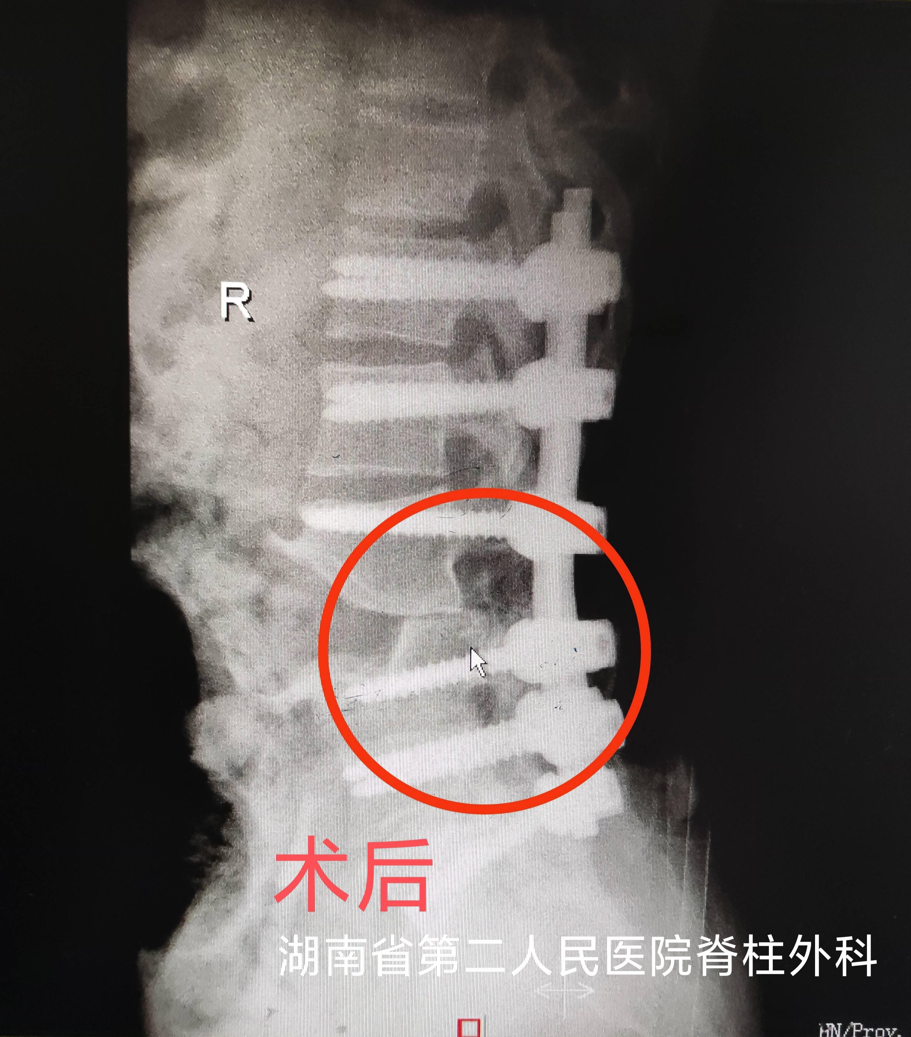 「科普」腰椎后凸畸形28年