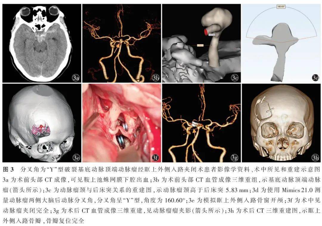 张鸿祺|中国脑血管病 | 眶上外侧入路夹闭后循环动脉瘤七例并文献复习