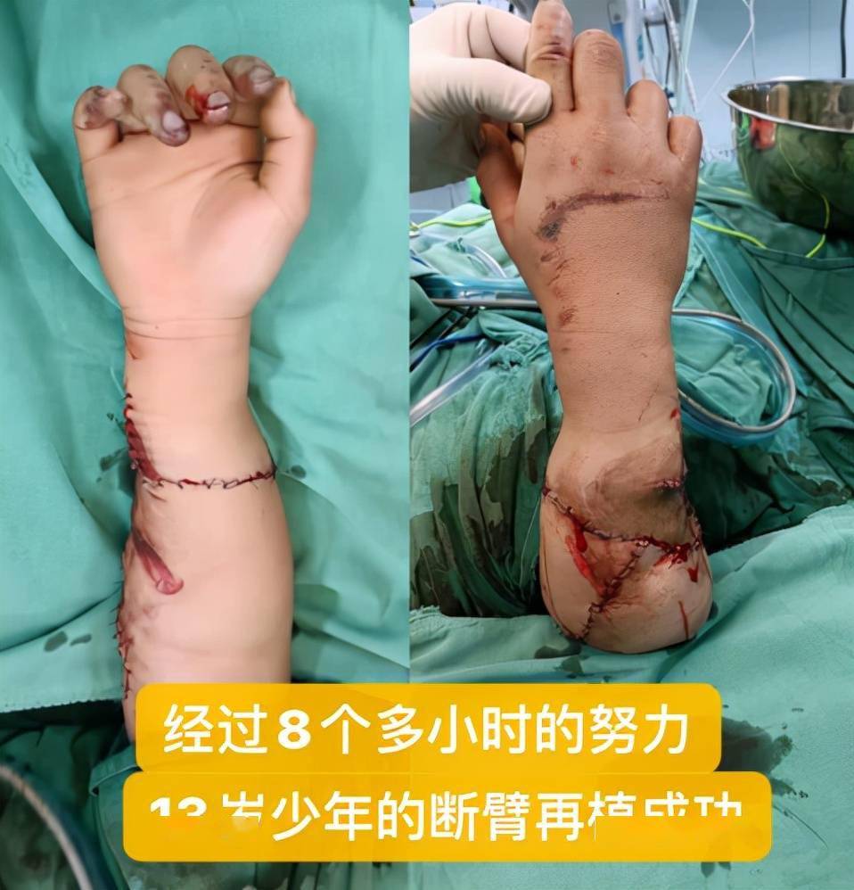 不平凡的小年夜丨13岁少年手臂被锯,医生连夜手术成功再植