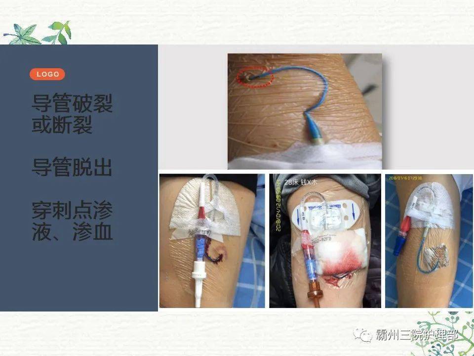 pptpicc的护理常规及冲封管流程