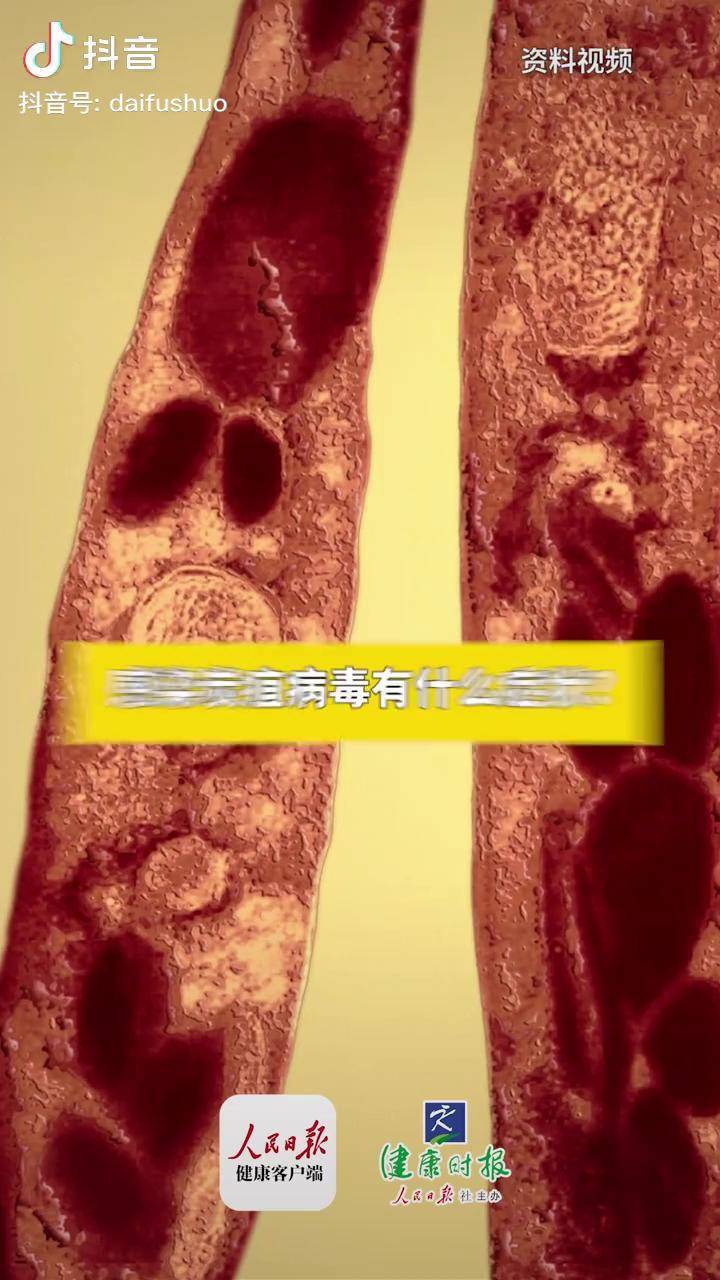 炭疽病 炭疽_病毒_症状_什么