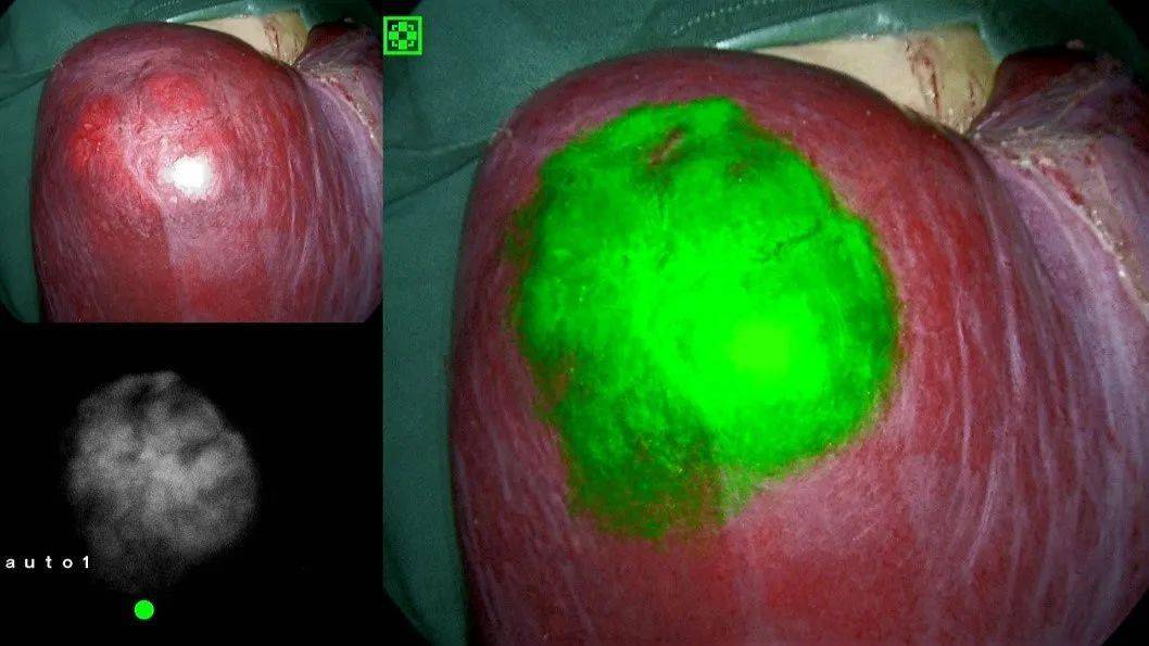 肝脏|【首儿医典】肝母细胞瘤