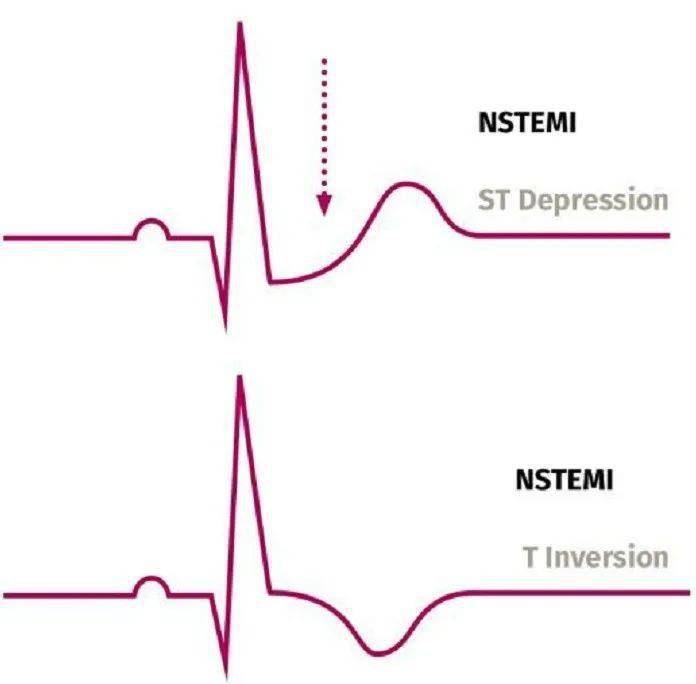 急性非st段抬高型心肌梗死即nstemi,顾名思义,该病心电图上st段没有