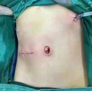 肝脏|【首儿医典】肝母细胞瘤