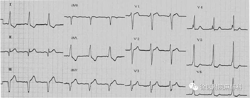 专题| 预激综合征的麻醉管理(徐医附院麻醉科)_心电图_旁路_窦性