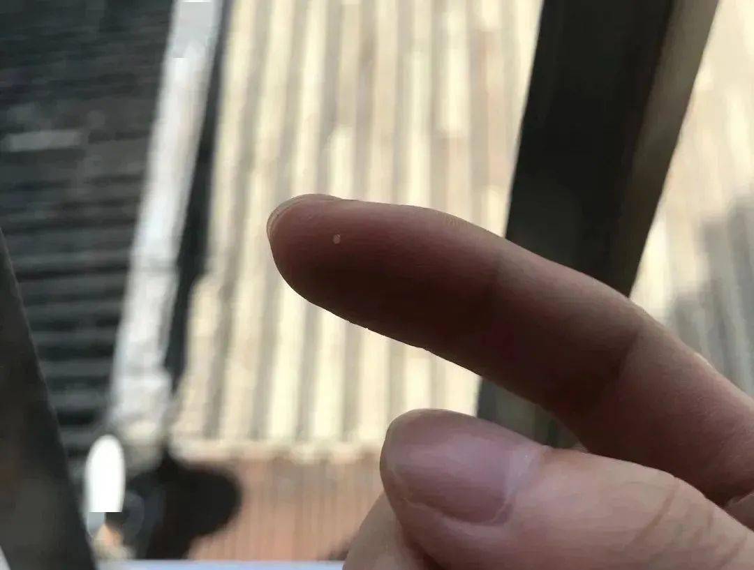 医学长了脂肪粒到底挤不挤?一分钟教你处理它的正确姿势!