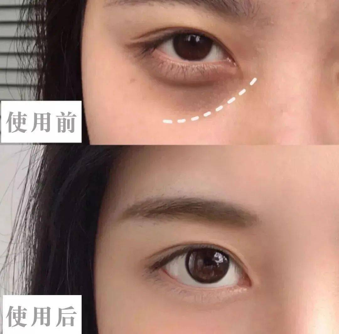 医学长了脂肪粒到底挤不挤?一分钟教你处理它的正确姿势!