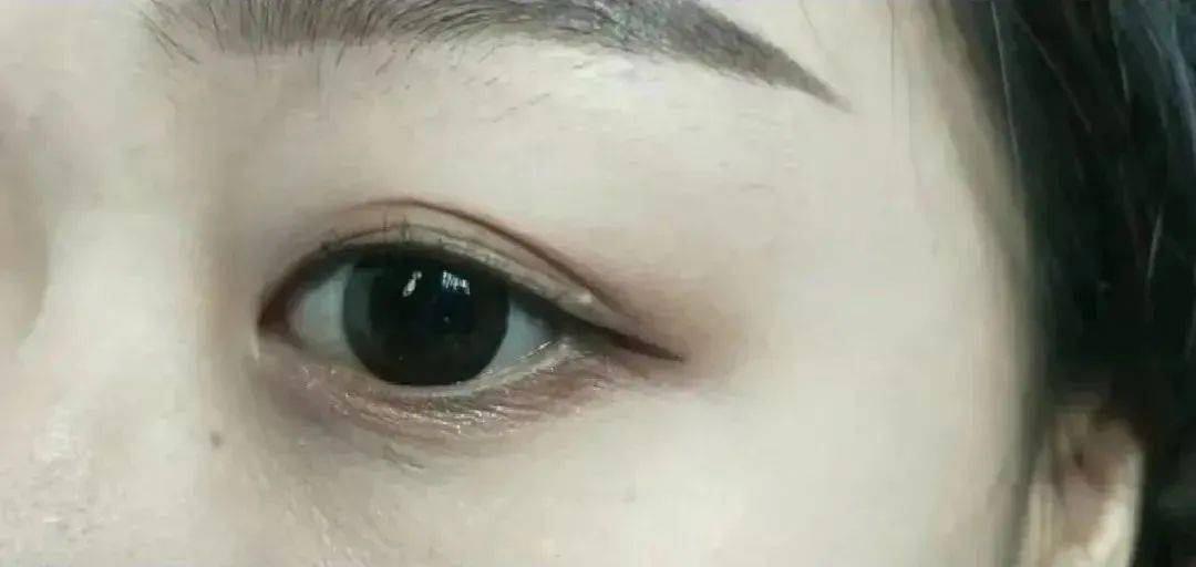 医学长了脂肪粒到底挤不挤?一分钟教你处理它的正确姿势!