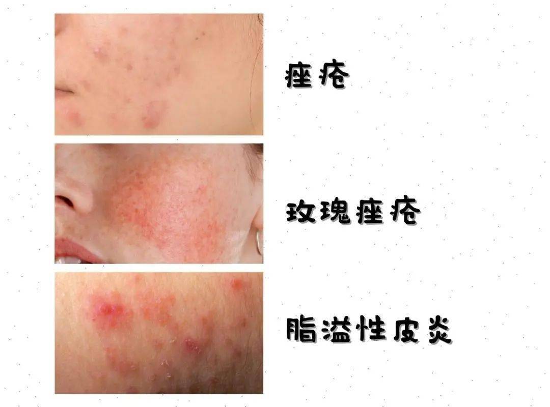 怎么又长痘还有可能是玫瑰痤疮和脂溢性皮炎哦