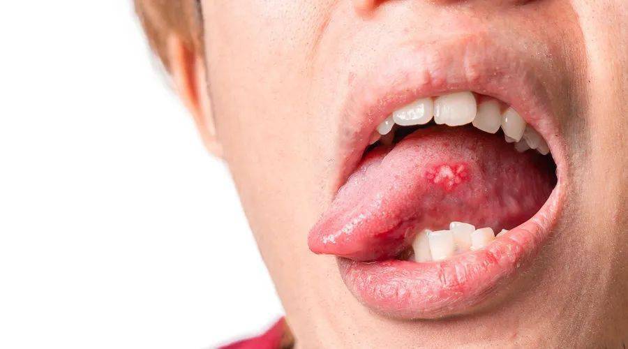 比这更难受的是咬破了口腔溃疡.