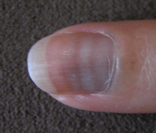 肾脏好不好看指甲就知道提醒指甲长成这3个样子及时就医