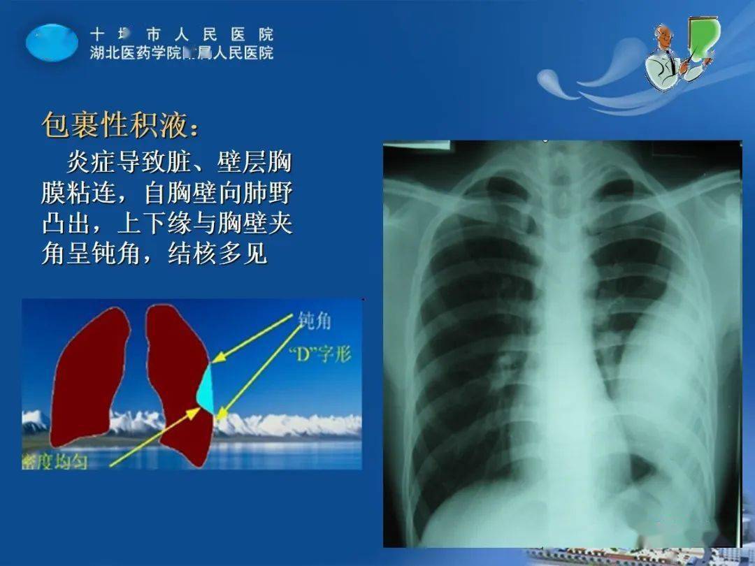 胸膜疾病影像表现