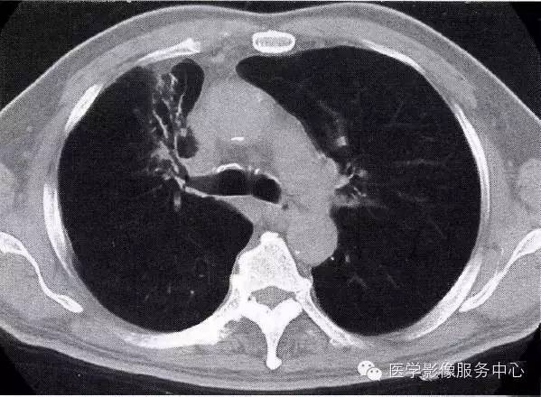 真菌|肺部炎症的“七大”常见CT表现