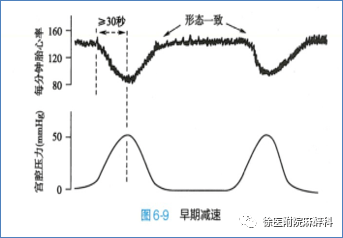 胎心早减:几乎与宫缩同步原因:胎头或脐带受压胎心晚减:宫缩压开始