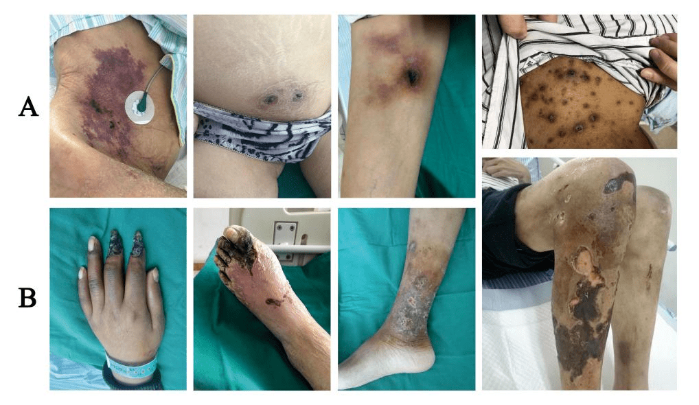 血液透析人群的钙化防御危险因素