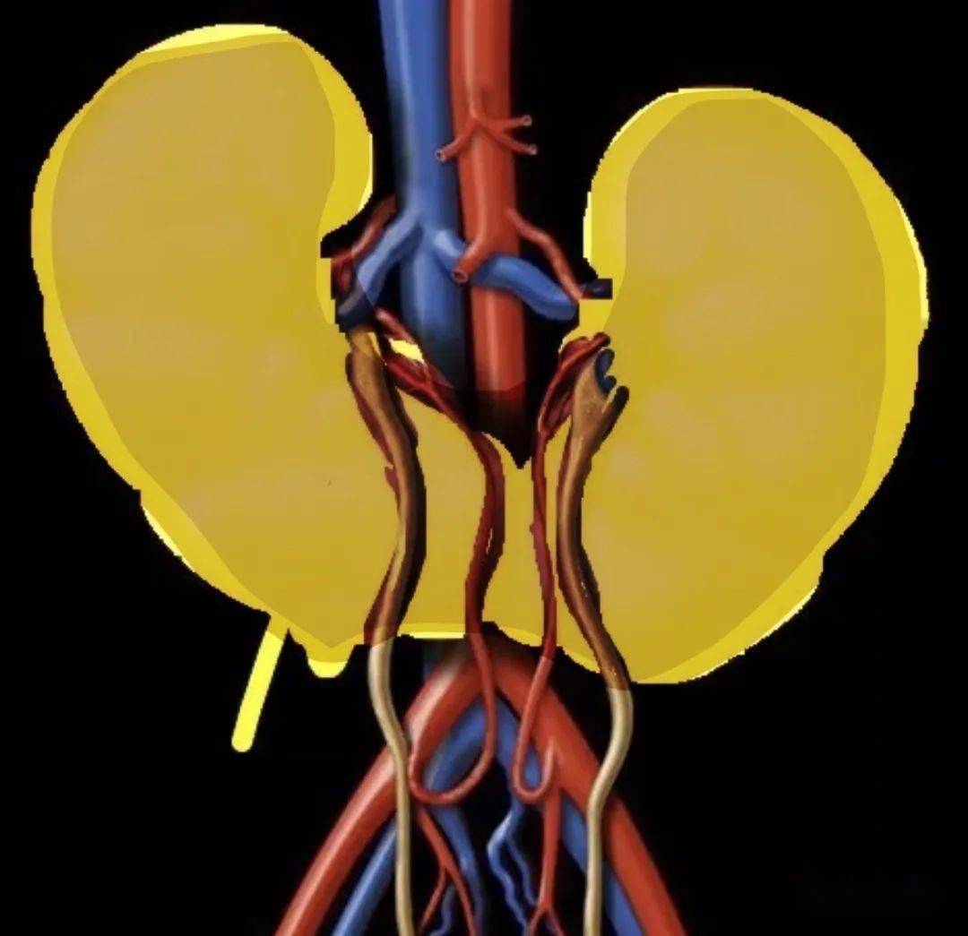 要想到下列圖像76雙腎下極融合,跨越脊柱和大血管,腹部橫切很重要!