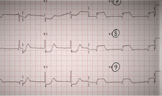 风湿性心脏病心电图图片