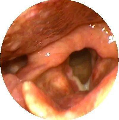术后2周创面大量白膜形成喉癌术后1周创面白膜形成喉原位癌,双侧声带