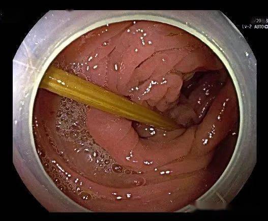 肠镜检查报告肠胃图片