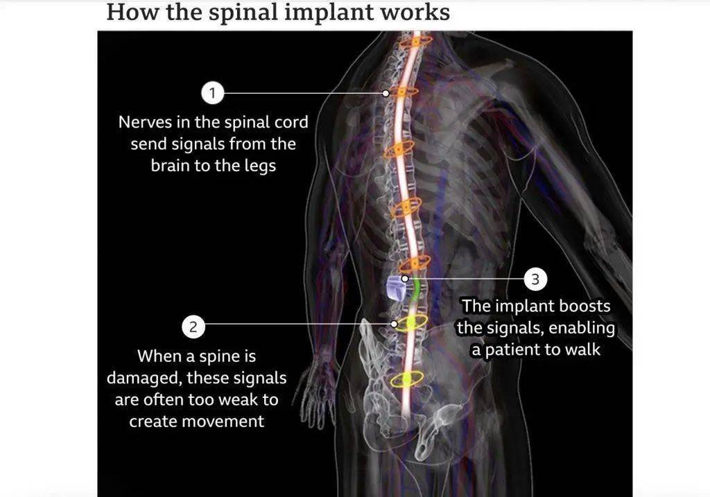 图片|植入物让脊髓被切断的瘫痪患者重新行走，医学上的「奇迹」？
