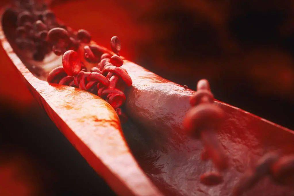 血液|《科学》：炎症竟会循“味儿”而动！科学家发现，血管巨噬细胞存在嗅觉受体，与血液中的辛醛互作引发炎症，导致动脉粥样硬化丨科学大发现