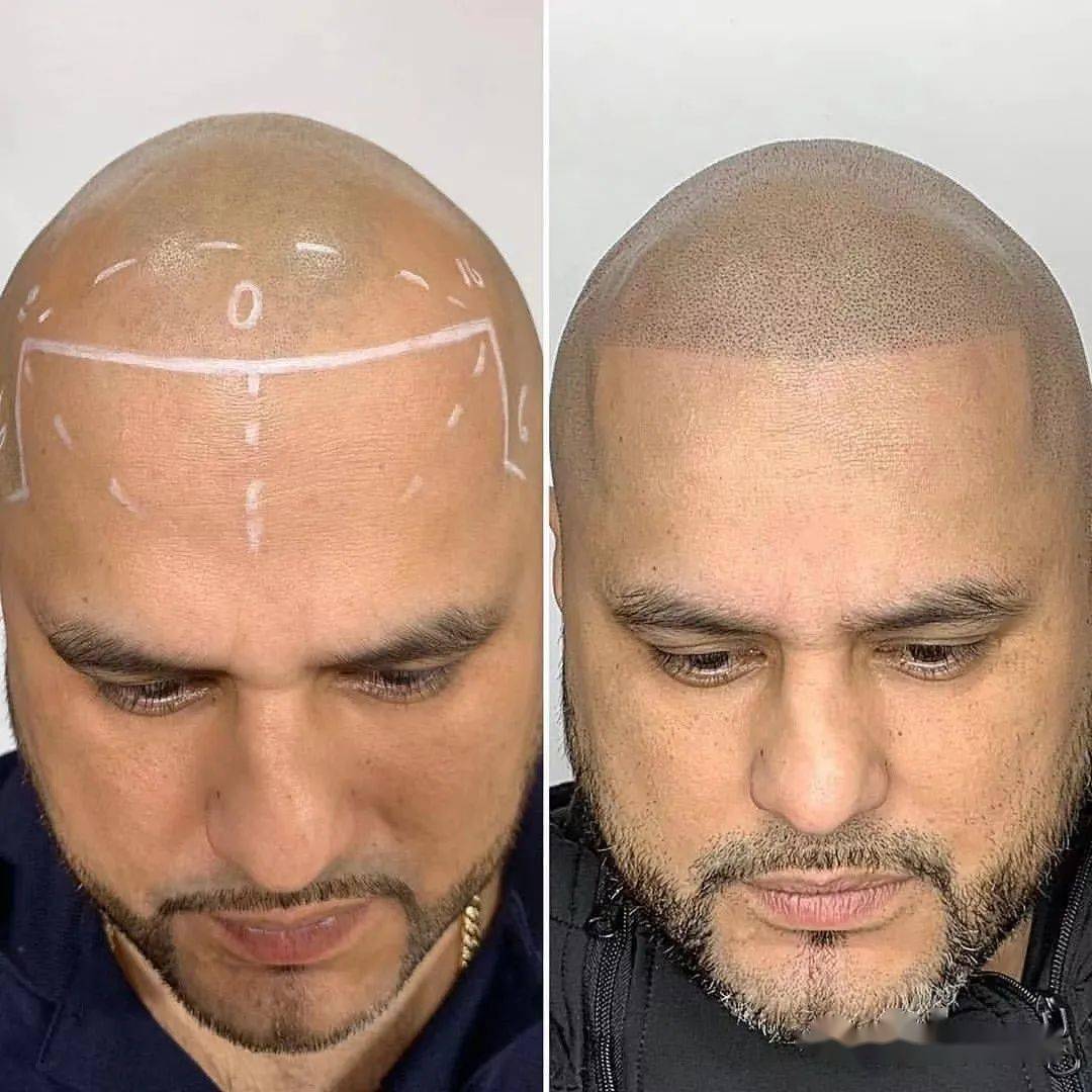 用纹身代替"植发",真的可行吗?_头皮_头发_杨幂