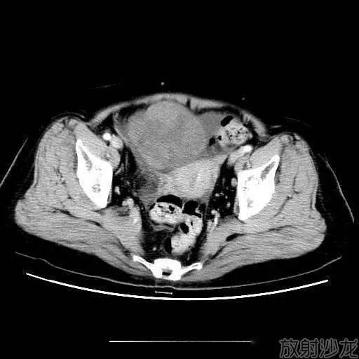 右侧卵巢囊性包块图片