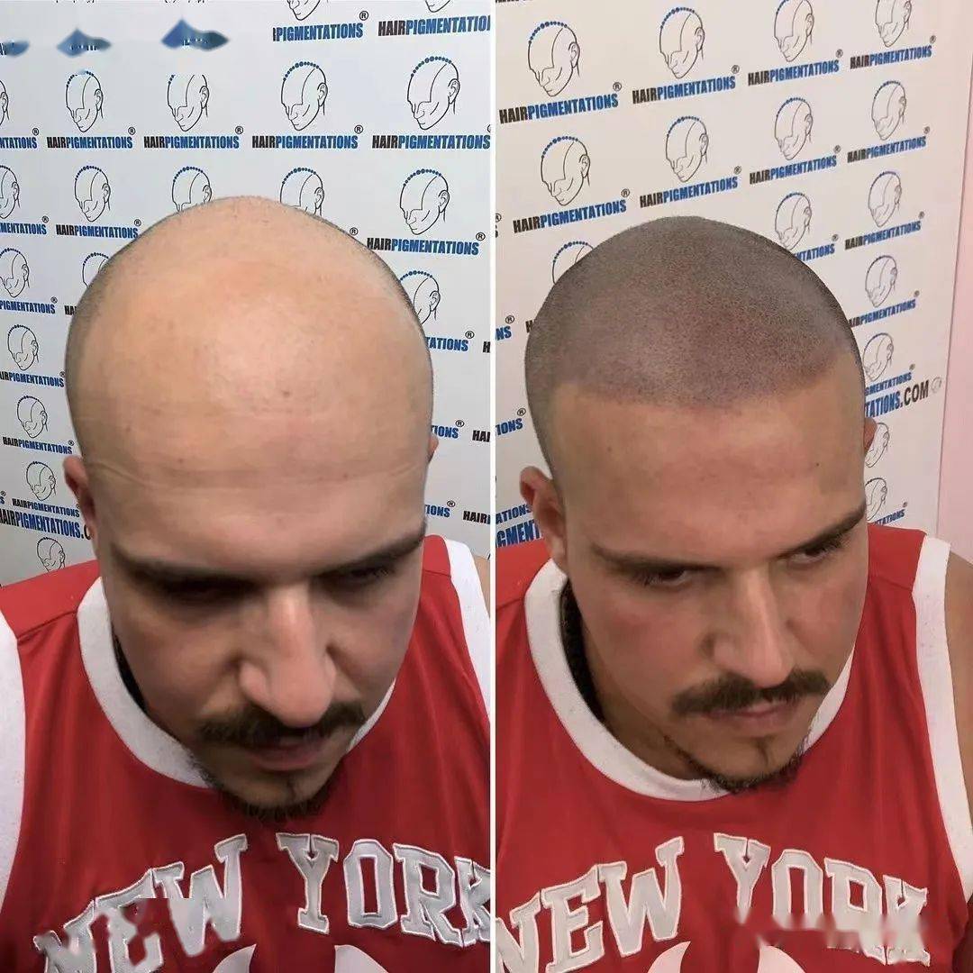 用纹身代替"植发",真的可行吗?_头皮_头发_杨幂