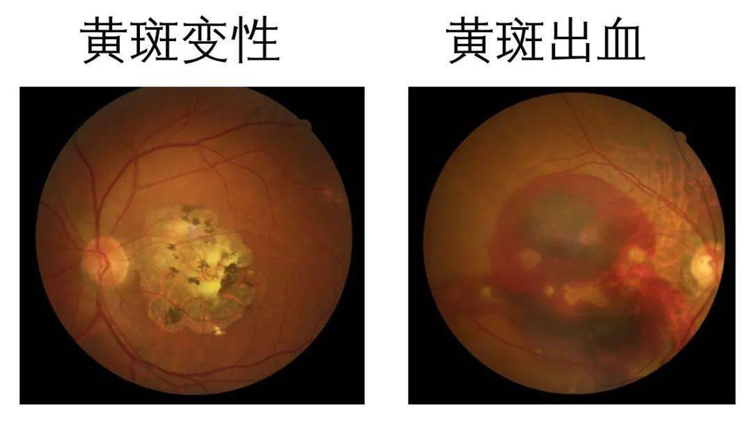黄斑出血高度近视的人,由于眼球变大造成对眼球壁的不断牵拉,就会引起