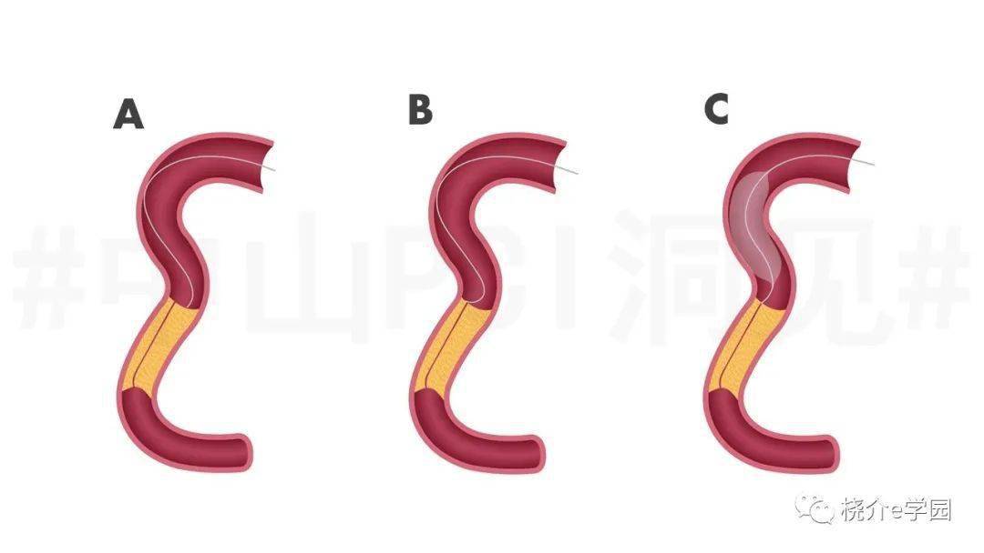 导丝塑形不理想,如何弥补?_黄浙勇_病变_导管