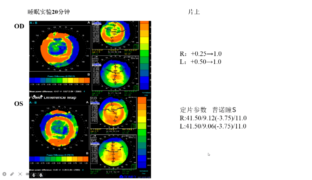 荧光素染色图显示:各弧段清晰可见,但眨眼过程中双眼均略偏向颞侧