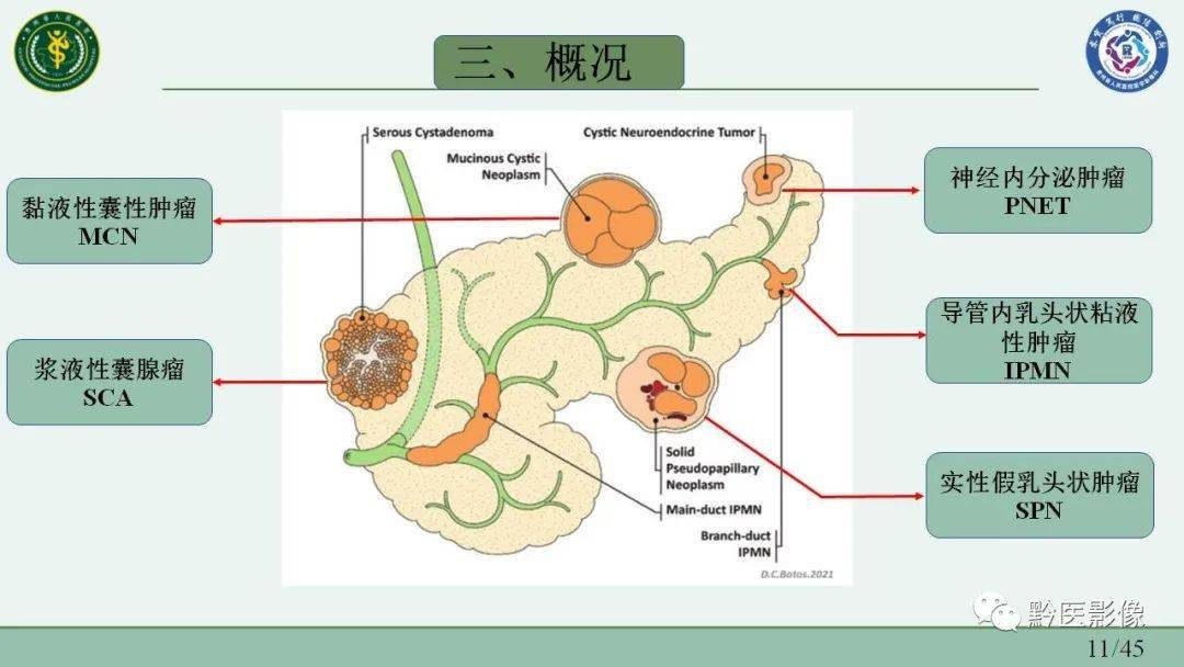 文献分享胰腺囊性病变影像学评估与病理