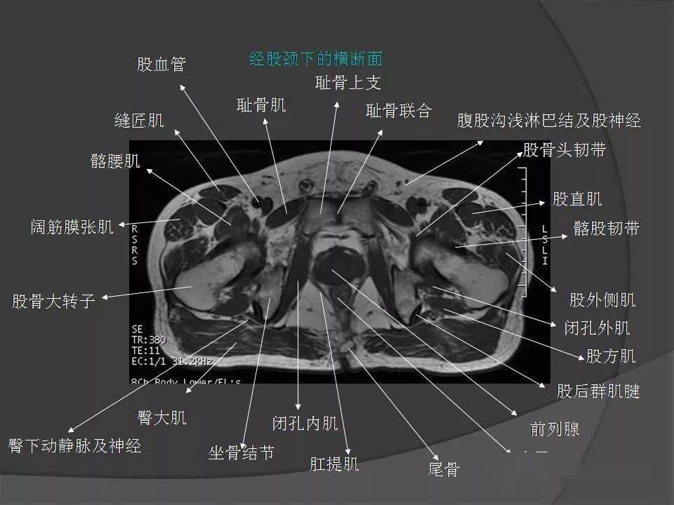 骨盆肌肉解剖mri標識