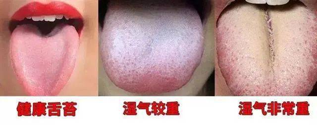舌苔越多,发黄发腻,寒湿越重!