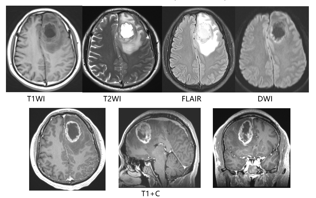 (1)术前mri,可见左侧额叶占位病变,不均匀强化,提示高级别胶质瘤