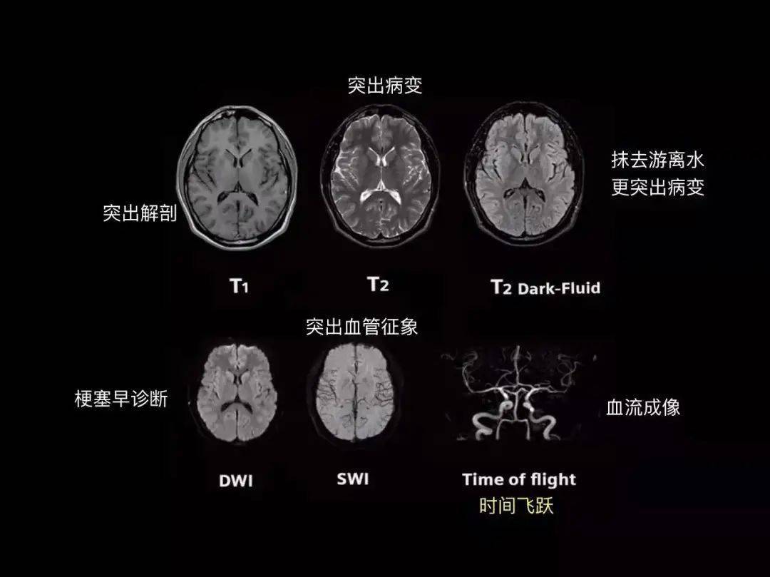 螺旋ct和普通ct的区别图片