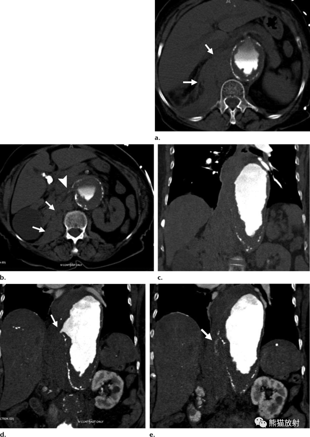 腹主动脉瘤的随访,哪些ct征象提示其不稳定性?