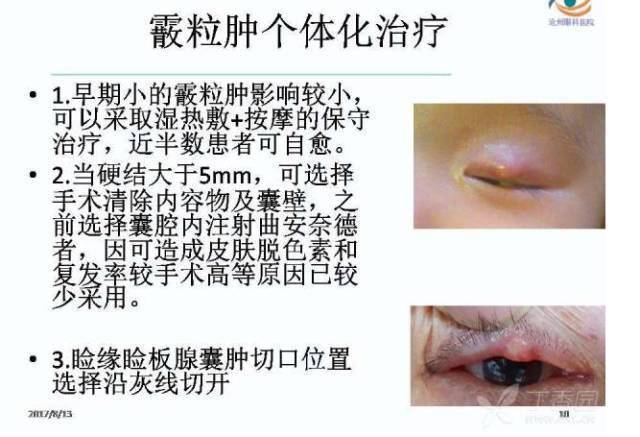 麦粒肿和霰粒肿的个体化分期治疗