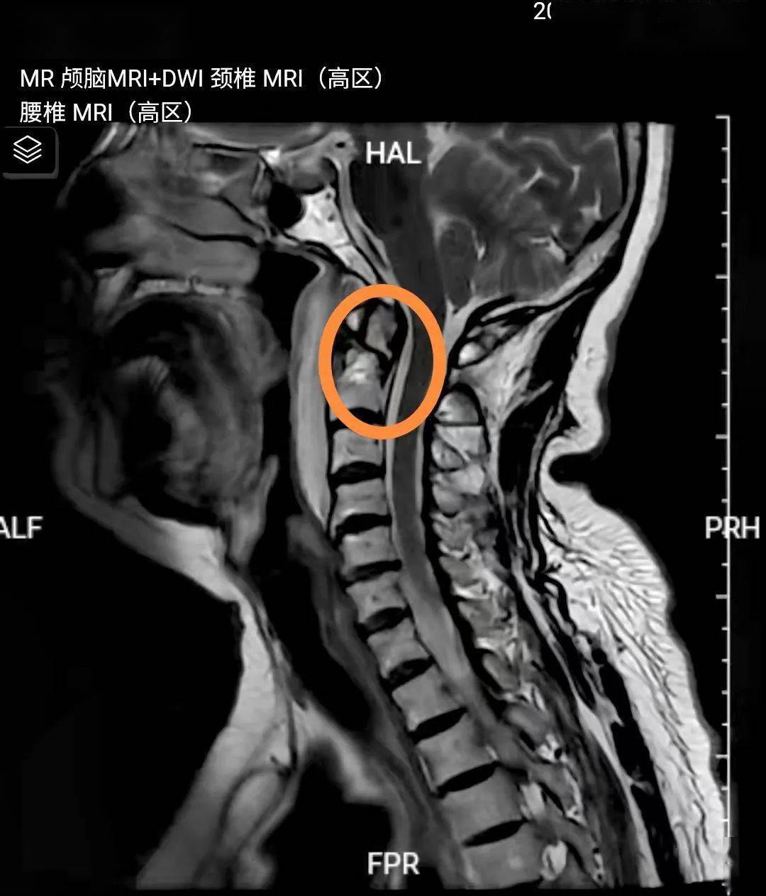 术前x光片59岁的马女士,入院前1小时因车祸致头颈部外伤