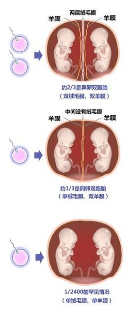 孕23周双胞胎之间脐带打结成麻花不幸夭折太可惜了