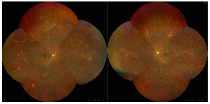 眼底一张照慢病早知道