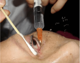 如果按摩效果不佳,在足月儿2-3月龄后可行泪道冲洗.