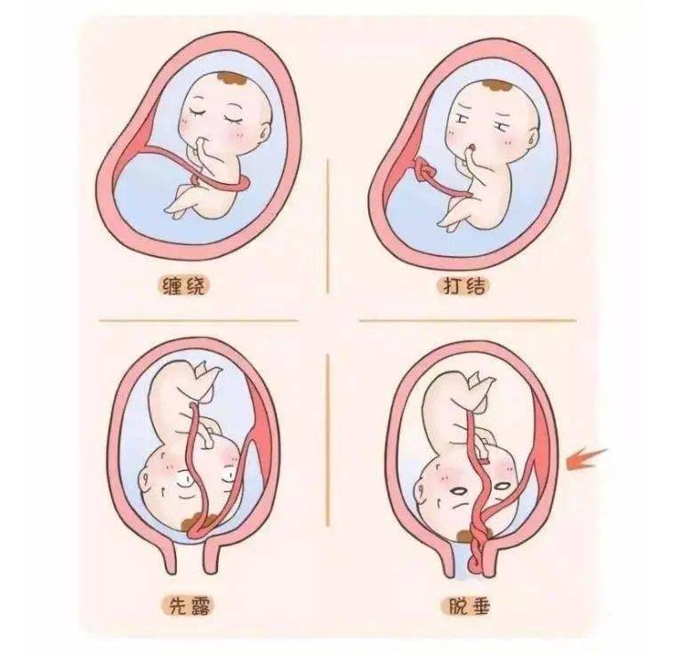 宝宝b超脐带图图片