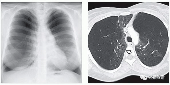 胸片图片肺气肿图片