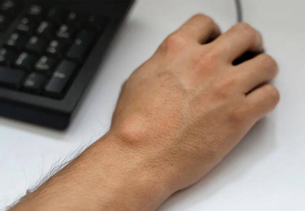 手腕上长了个包是怎么回事?【腱鞘囊肿】要开刀吗?