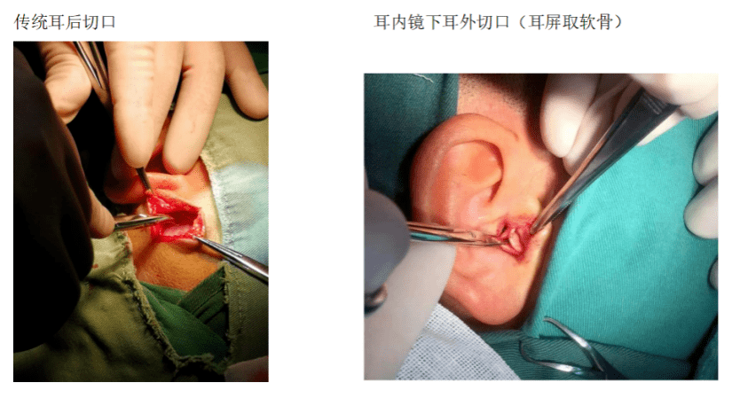 耳膜修复手术图片