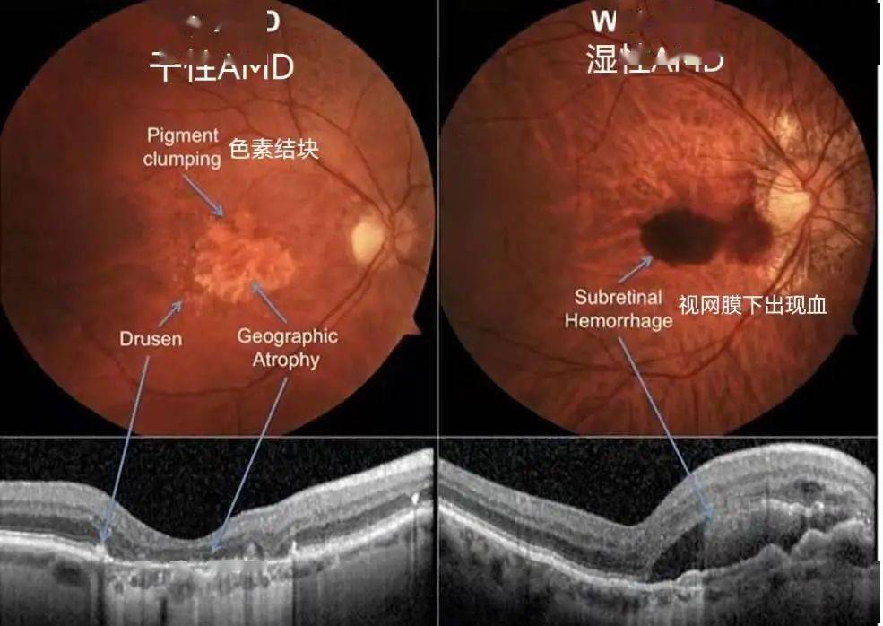 视网膜黄斑病变前兆表现是什么？