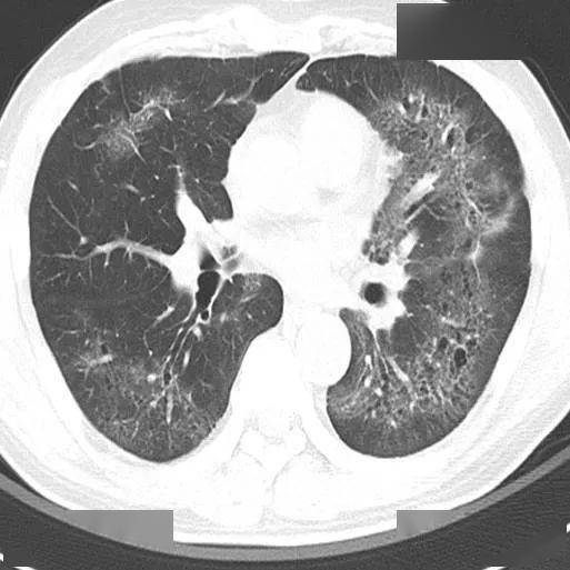 胸部|这个间质性肺炎，还挺少见的