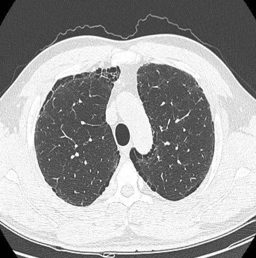 胸部|这个间质性肺炎，还挺少见的