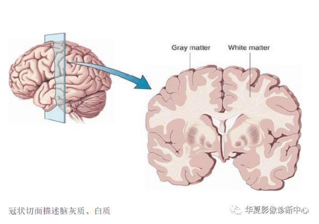 区内|MR脑白质区内斑点影，腔梗、脱髓鞘、缺血灶，应如何书写影像报告